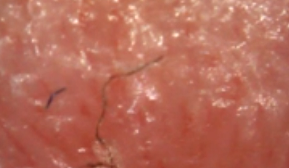 Morgellons diagnosis of multibacterial infection - disease ...