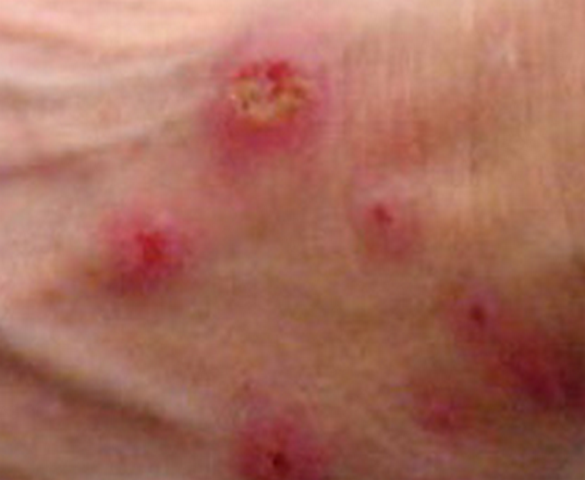 Shocking Morgellons Disease Actual Pictures