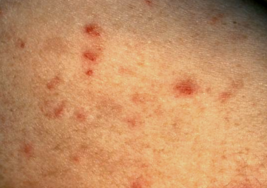 Skin conditions relating to HIV infection | DermNet New ...