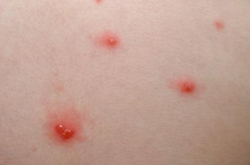 Tiny Red Spots on Skin (Petechiae): Causes and Treatments