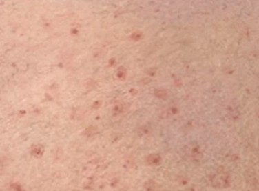 Periorbital Dermatitis: It's Not Every Rash ... - Medscape