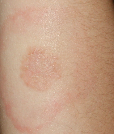 Lyme Disease Symptoms, Rash , Treatments - MedicineNet