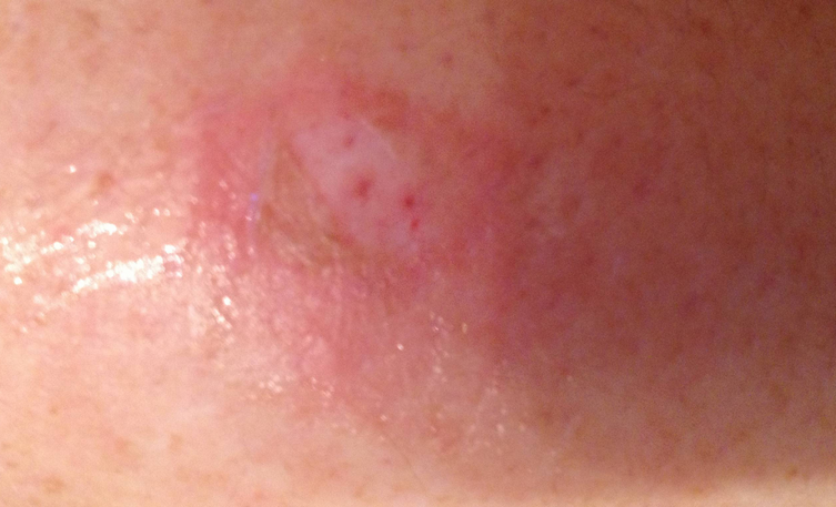 Where can one find photographs of spider bites?