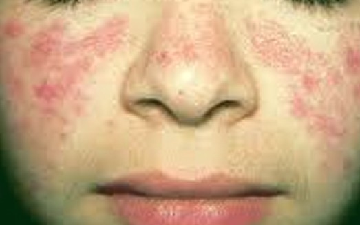 Lupus Rash  Photos, Symptoms, Causes, Treatment, Pictures