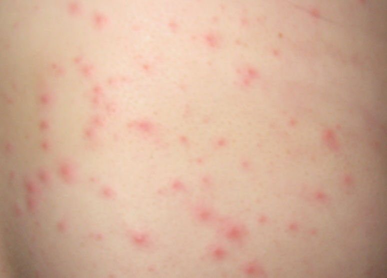 Rash : Check Your Symptoms and Signs – MedicineNet