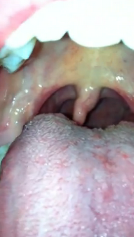 White Patch In The Back Of My Throat