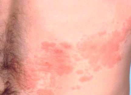 skin rash on abdomen - MedHelp
