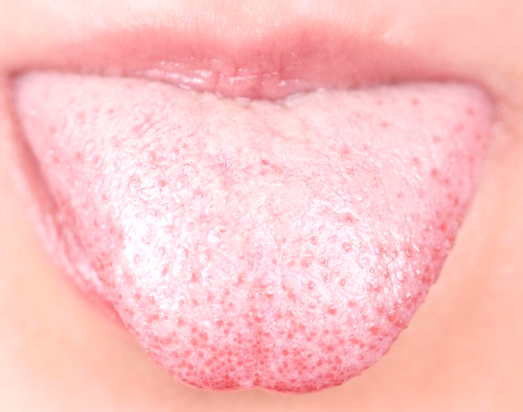 3 Ways to Get Rid of Bumps on Your Tongue - wikiHow