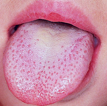 eruptive lingual papillitis