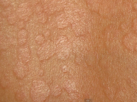 tinea versicolor symptoms #10