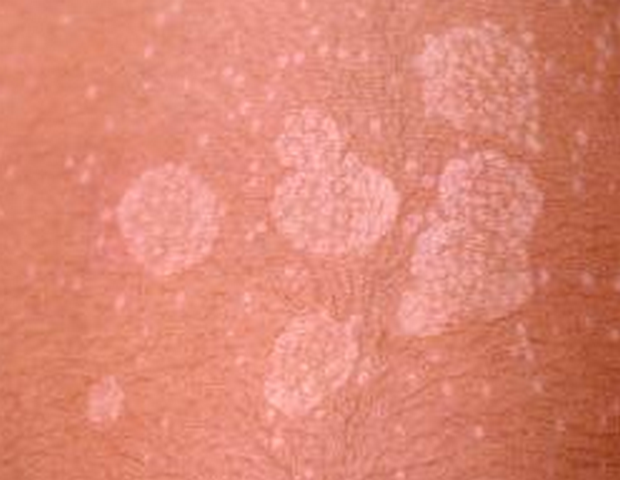 Tinea versicolor Causes - Mayo Clinic