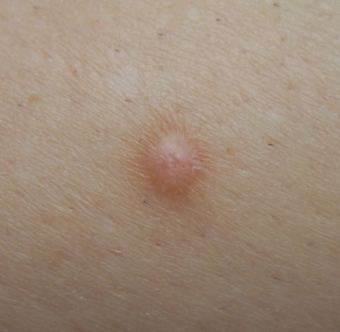 Dermnet: Dermatology Pictures - Skin Disease Pictures