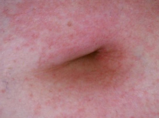 Rash below belly button