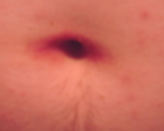 Belly button rash - causes, treatment, pictures