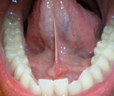 How do you care for painful lumps on the tongue?