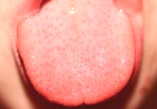 Red Dry Patch On Tongue