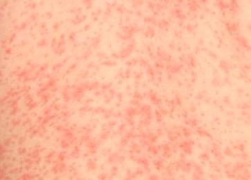 Heat rash - Mayo Clinic