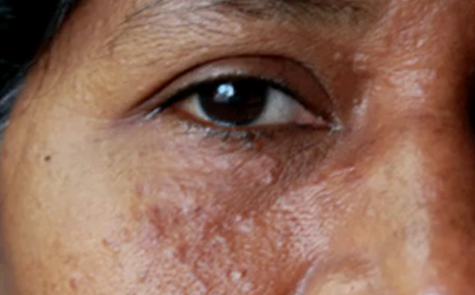 Online Dermatology - Syringoma