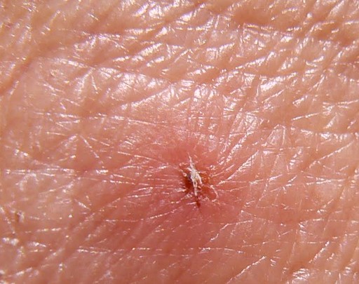 Insect bites and stings - Treatment - NHS Choices