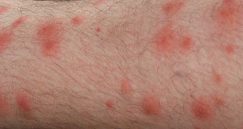 Chigger Bites – Pictures, Symptoms, Causes, Treatment – Inside the Clinic