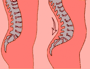 Lumbar Lordosis Fix Symptoms Causes Treatment Pictures