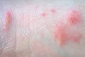 Pictures of Poison Ivy Rash, Images, Symptoms, Treatment