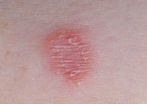 Does ringworm itch? Images, Symptoms, Causes, Treatment