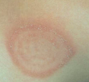 Does ringworm itch? Images, Symptoms, Causes, Treatment