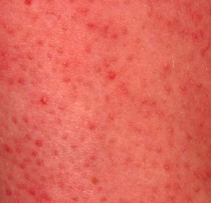 Keratosis Pilaris – Inside the Clinic