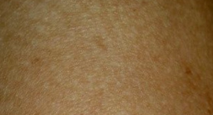 Chlorine Rash - Pictures, Treatment, Symptoms, Causes