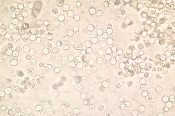 Pus Cells In Urine 7350