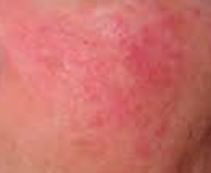 Gluten Rash - Symptoms, Causes, Treatment, Pictures