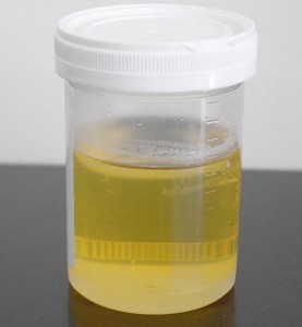 Turbid Urine - Causes