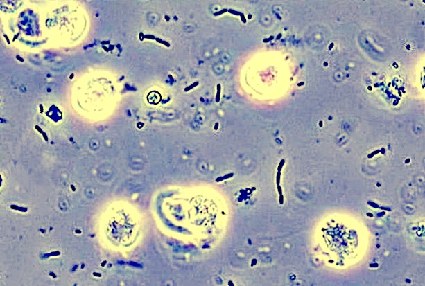 High Leukocytes in Urine pics