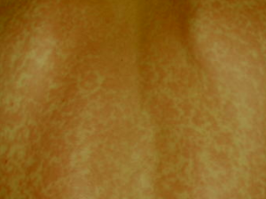 Viral Exanthem Rash - Pictures, Treatment, Symptoms,